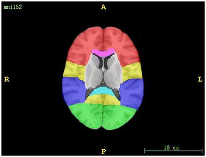 Regional white matter hyperintensity volume predicts persistent cognitive impairment in acute lacunar infarct patients